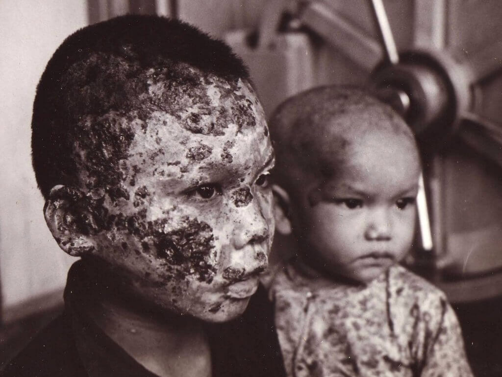Victim of napalm, Vietnam War