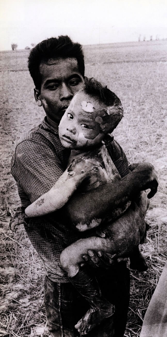 Victim of napalm gas, Vietnam